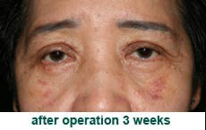 plastic-surgery-blepharoplasty